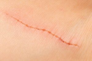 Close up image of a small scar where you can see the lines of tension in the skin around it.
