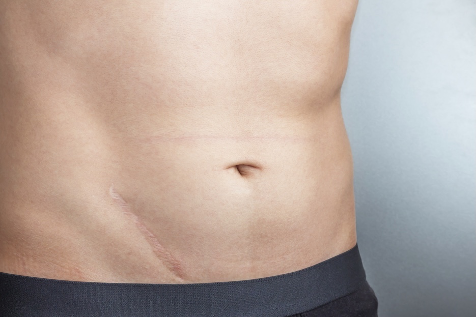 ScarWork for Keyhole and Small Scars Male torso with scar from surgery around the pelvis. ScarWork for Keyhole and Small Scars