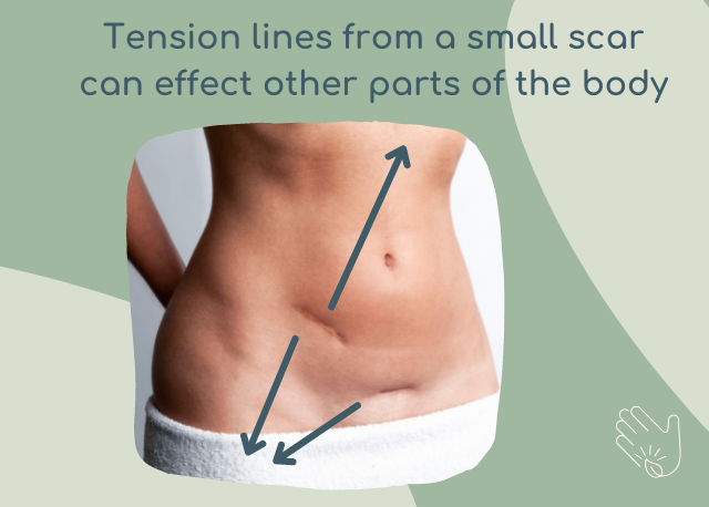 Tension Lines From Adhesions affecting other parts of the body Image of an abdomen with a couple of surgery scars and arrows to show Tension Lines From Adhesions affecting other parts of the body